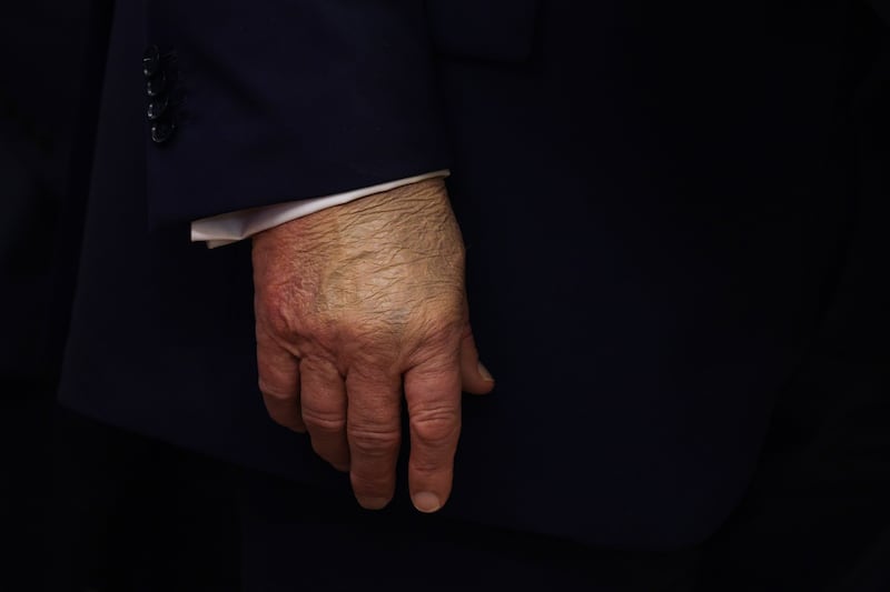A detailed view of the hand  President Donald Trump's hand covered in makeup on September 2.
