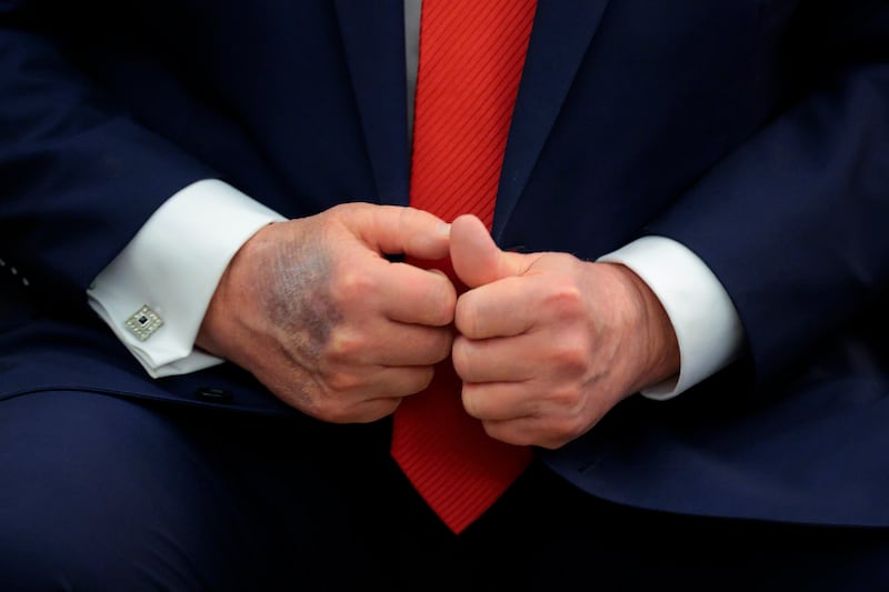 A bruise is visible on the back of U.S. President Donald Trump's right hand during a meeting with  South Korean President Lee Jae-myung in the Oval Office at the White House on August 25, 2025 in Washington, DC.