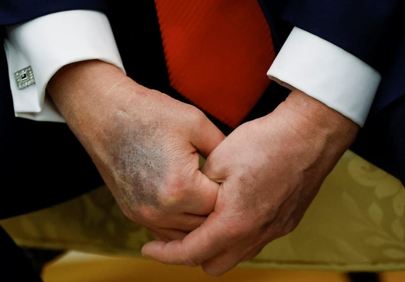 The bruised right hand of U.S. President Donald Trump is visible during a meeting with South Korean President Lee Jae Myung at the Oval Office, at the White House, in Washington, D.C., U.S., August 25, 2025.